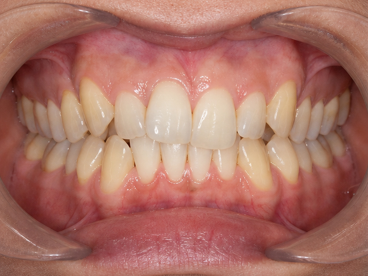 Antes — Intraoral F