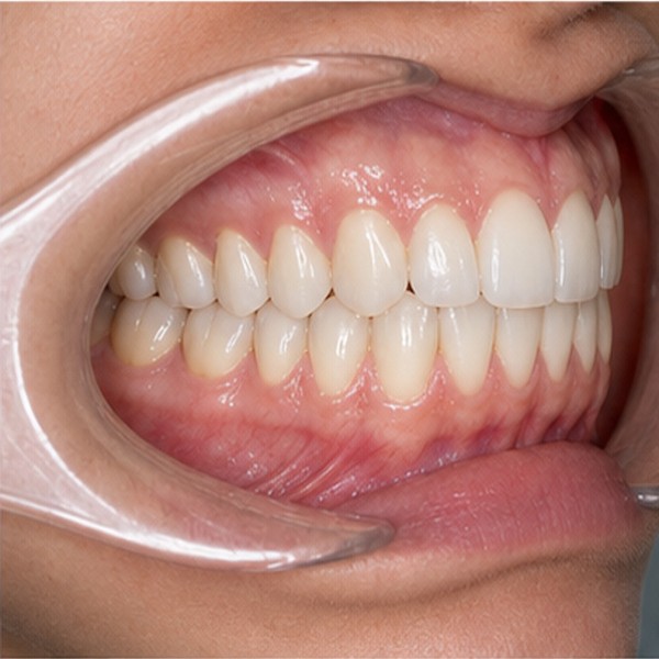 Vista clínica: Intraoral D