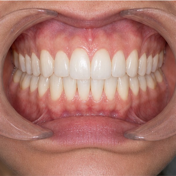 Vista clínica: Intraoral F