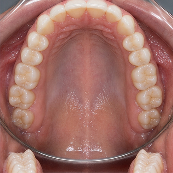 Vista clínica: Oclusal sup
